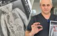 Львівські хірурги врятували 2-річну дитину, яка всю зиму прожила із батарейкою у стравоході