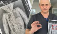 Львівські хірурги врятували 2-річну дитину, яка всю зиму прожила із батарейкою у стравоході